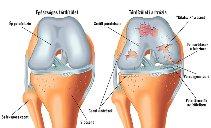Térd artrózis &#8211; gyakori ízületi megbetegedés