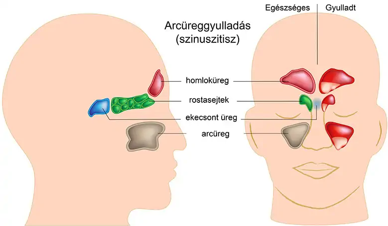 Arcüregek helye és az arcüreggyulladás kialakulása