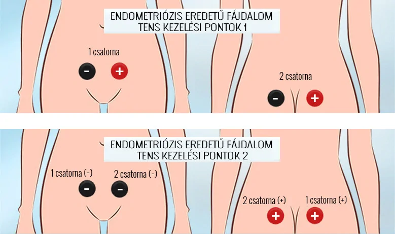 endometriózis kezelése TENS, MENS kezeléssel, elektróda elhelyezései pontok