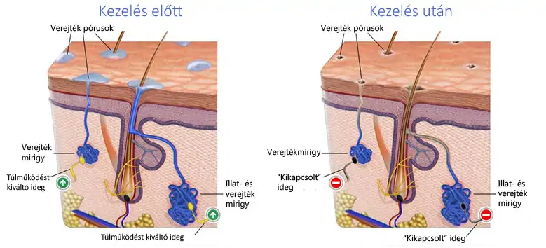 verejtékmirigyek kóros izzadás hiiperhidrosis esetén csapvíz iontoforézis kezelés előtt és után