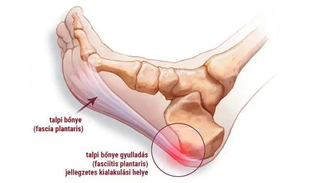 talpi bőnye gyulladás fasciitis plantaris