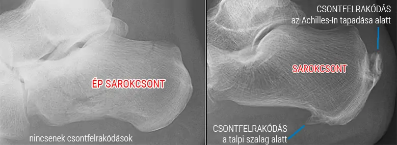 sarkanytú sarokcsont kinövés csontkinövés