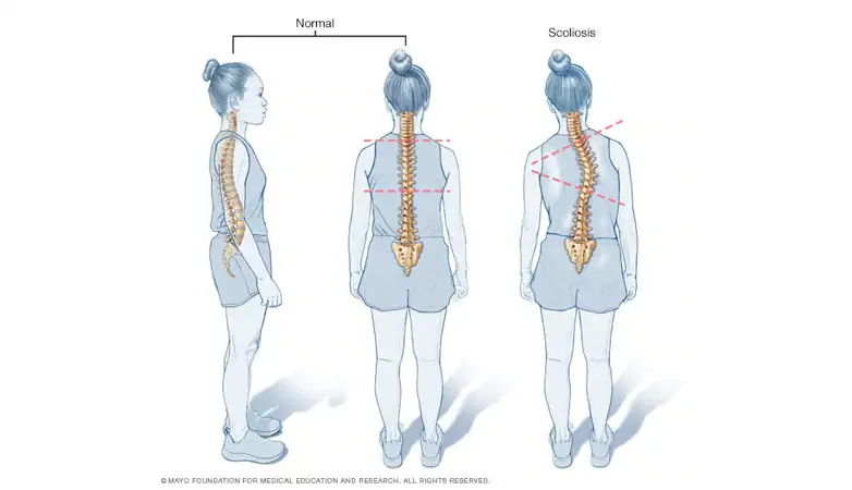 Skoliózis, azaz gerincferdülés