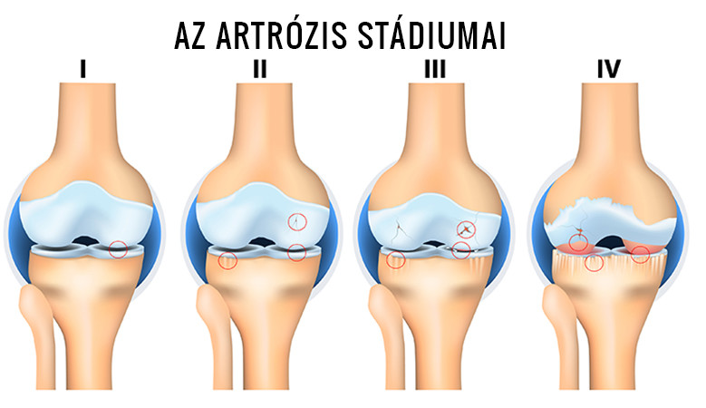 Artrózis stáiumai
