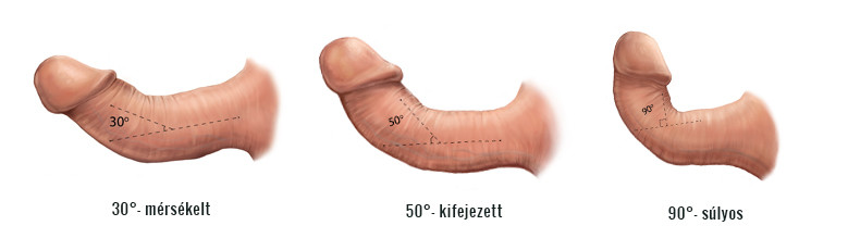 a Peyronie-betegség fokozatai