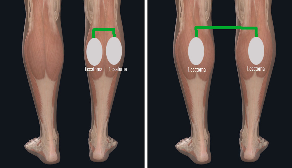 elektródák felhelyezése veinoplus Arterial, veinoplus V.I. és veinoplus DVT készülékkel végzett kezeléshez
