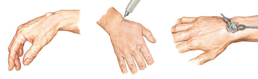 ganglion ciszta műtéti eltávolítása