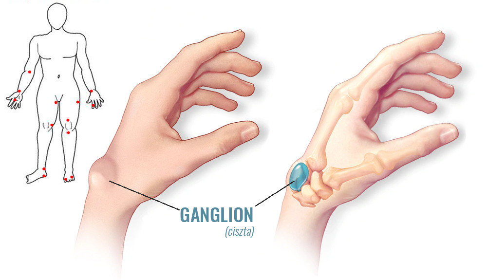 ganglion ciszta és jellegzetes előfordulási helyei