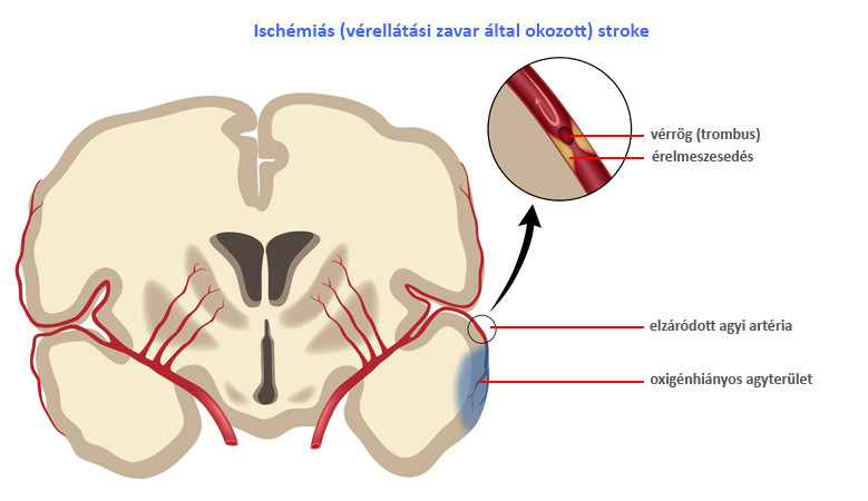ischaemiás stroke kialakulása