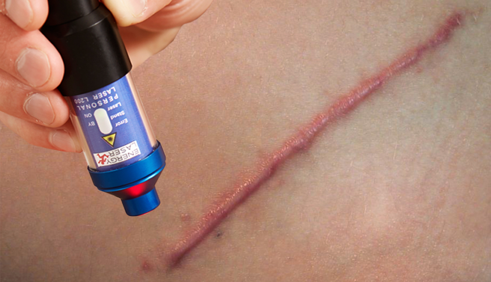 keloid kezelése L400 lágylézerrel