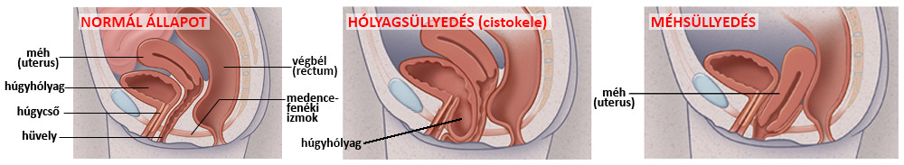 méhsüllyedés és hólyagsüllyedés