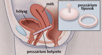pesszárium típusok