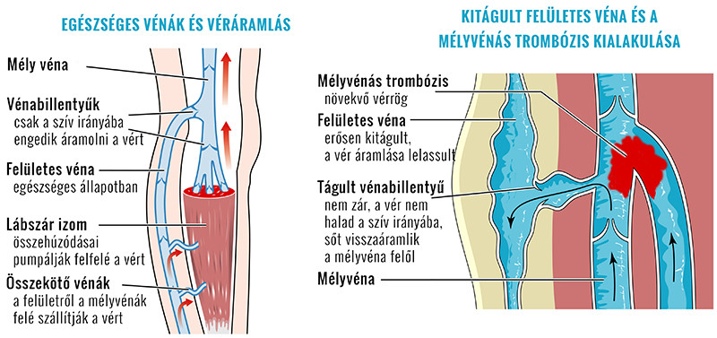 trombőzis kialakulásának folyamata